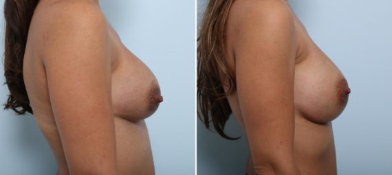 Breast Implant Exchange Before and After Photos in Houston, TX, Patient 52789
