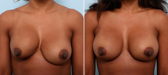 Not Happy With Your Breast Implants? You Have Options, Before and After Photos Breast Augmentation with Strattice Before and After Photos in Houston, TX, Patient 27202
