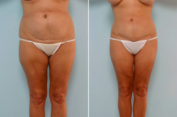 Will a Tummy Tuck Fix Stretch Marks?, Before and After Photos Abdominoplasty Before and After Photos in Houston, TX, Patient 24588