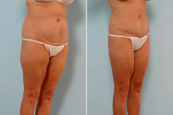 Abdominoplasty Before and After Photos in Houston, TX, Patient 24588