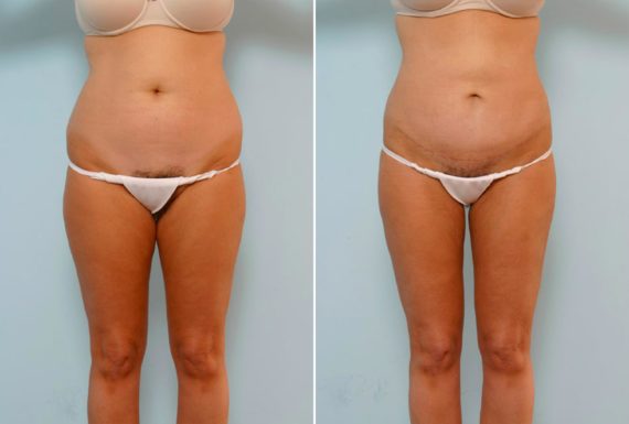 Abdominoplasty Before and After Photos in Houston, TX, Patient 24480