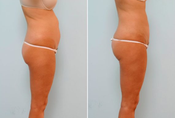 Will a Tummy Tuck Fix Stretch Marks?, Before and After Photos Abdominoplasty Before and After Photos in Houston, TX, Patient 24480