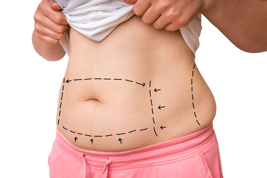 A tummy tuck is a cosmetic procedure done to reduce abdominal fat giving a more toned and muscular appearance. 