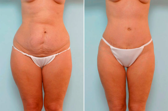 Which Type of Tummy Tuck Should I Go For?, Before and After Photos Abdominoplasty Before and After Photos in Houston, TX, Patient 24624