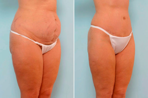 Which Type of Tummy Tuck Should I Go For?, Before and After Photos Abdominoplasty Before and After Photos in Houston, TX, Patient 24624