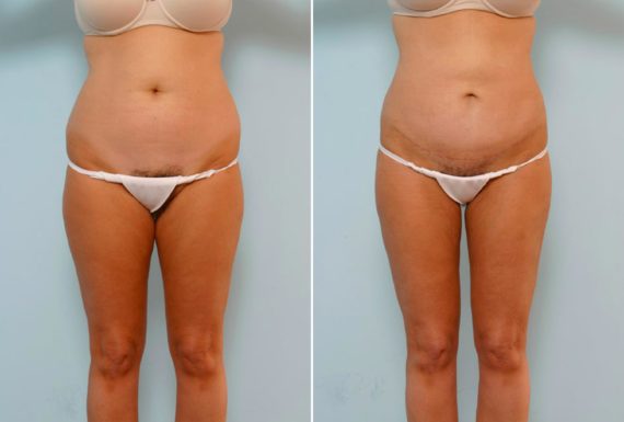 Which Type of Tummy Tuck Should I Go For?, Before and After Photos Abdominoplasty Before and After Photos in Houston, TX, Patient 24480