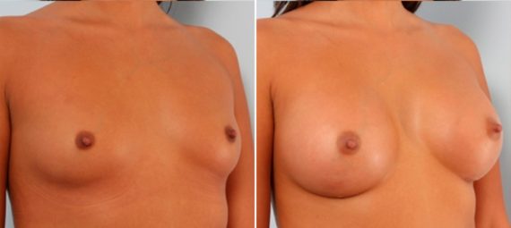 Breast Augmentation Before and After Photos in Houston, TX, Patient 24710