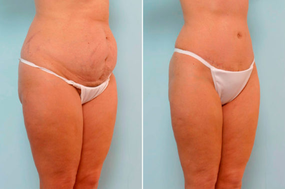 Abdominoplasty Before and After Photos in Houston, TX, Patient 24624