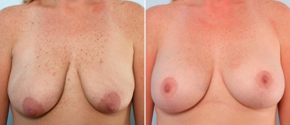 Breast Lift Before and After Photos in Houston, TX, Patient 57738
