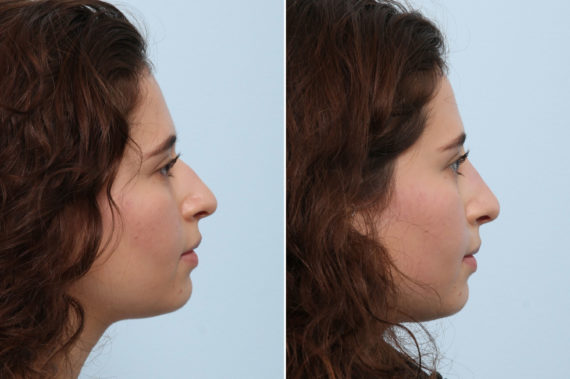 How Does Liquid Rhinoplasty Work?, Before and After Photos Non-Surgical Rhinoplasty Before and After Photos in Houston, TX, Patient 58648