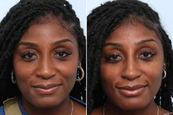How Does Liquid Rhinoplasty Work?, Before and After Photos Non-Surgical Rhinoplasty Before and After Photos in Houston, TX, Patient 58675