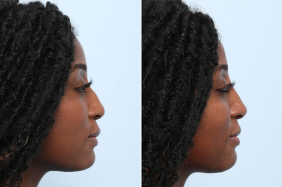 Non-Surgical Rhinoplasty Before and After Photos in Houston, TX, Patient 58675