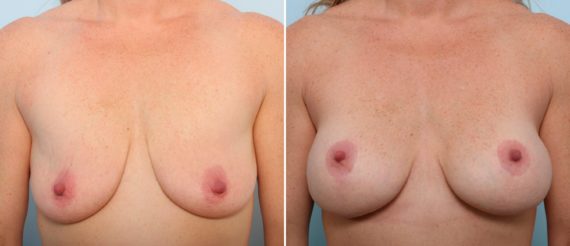 Breast Lift Before and After Photos in Houston, TX, Patient 57696