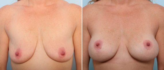 What Are The Most Common Procedures For A Mommy Makeover?, Before and After Photos Breast Lift Before and After Photos in Houston, TX, Patient 57696