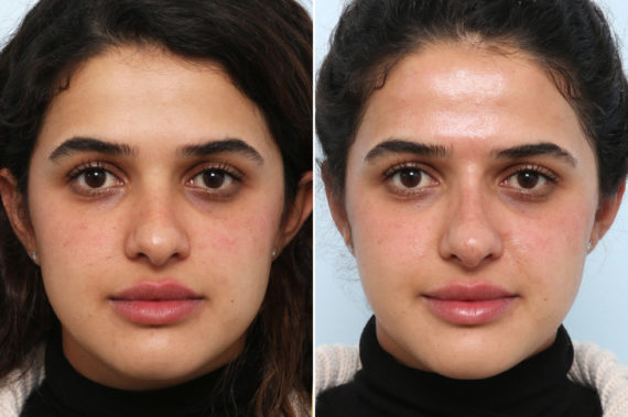 How Can You Get Natural Looking Results with Injectables?, Before and After Photos Non-Surgical Rhinoplasty Before and After Photos in Houston, TX, Patient 58821