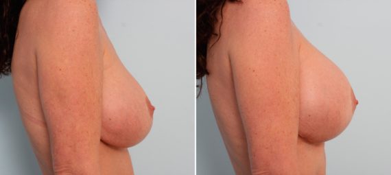 Breast Implant Exchange Before and After Photos in Houston, TX, Patient 27419
