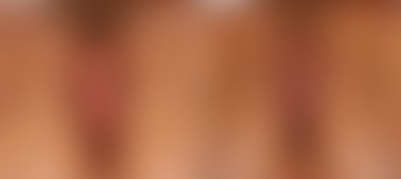 5 Ways A Labiaplasty Can Boost Your Confidence, Before and After Photos Labiaplasty Before and After Photos in Houston, TX, Patient 28733