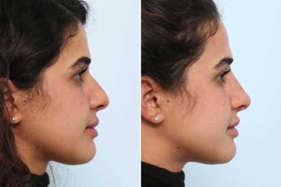 What Are The Pros and Cons of a Non-Surgical Rhinoplasty?, Before and After Photos Non-Surgical Rhinoplasty Before and After Photos in Houston, TX, Patient 58821