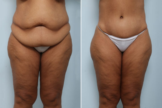 Body Lift Before and After Photos in Houston, TX, Patient 59137