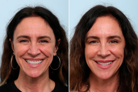 5 Other Things Botox Can Do, Before and After Photos Botox® Cosmetic Before and After Photos in Houston, TX, Patient 59236