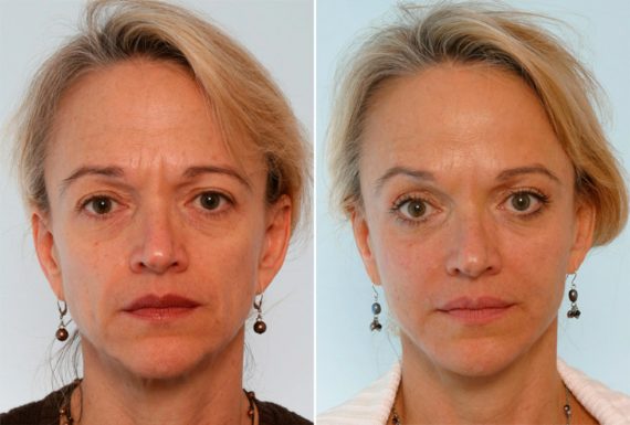 5 Other Things Botox Can Do, Before and After Photos Botox® Cosmetic Before and After Photos in Houston, TX, Patient 27062
