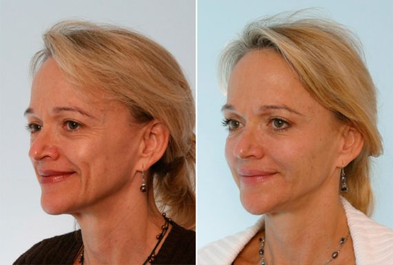 BotoxÂ® Cosmetic Before and After Photos in Houston, TX, Patient 27062