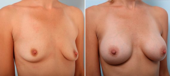 Breast Augmentation Before and After Photos in Houston, TX, Patient 42287
