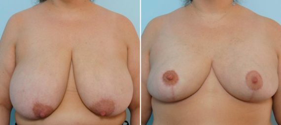 Breast Reduction Before and After Photos in Houston, TX, Patient 27601