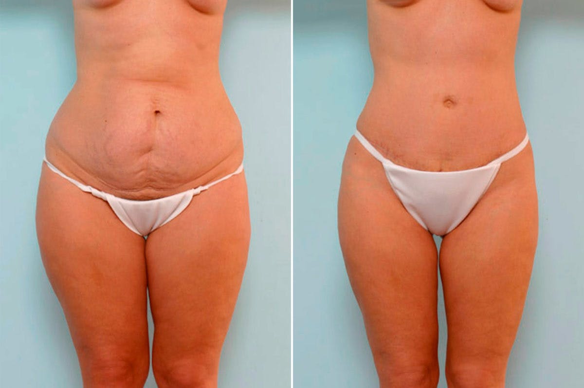 Abdominoplasty Before & After Gallery - Patient 54865571 - Image 1