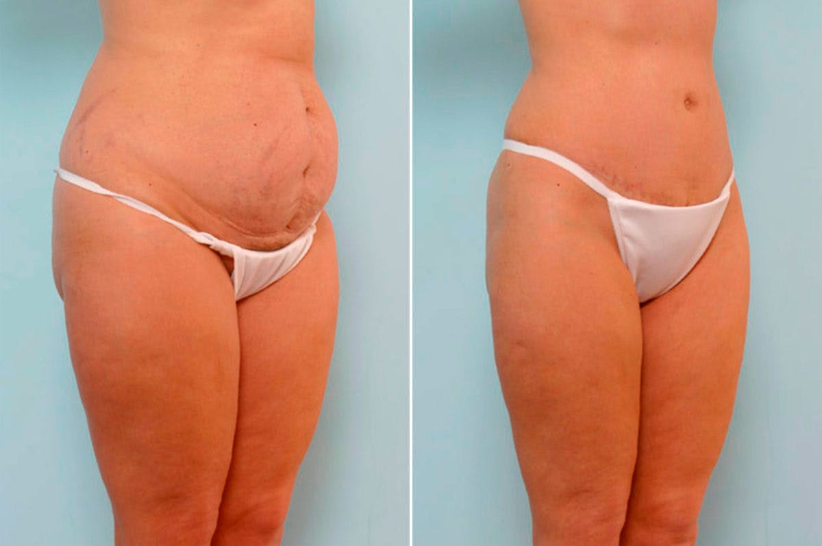 Abdominoplasty Before & After Gallery - Patient 54865571 - Image 2
