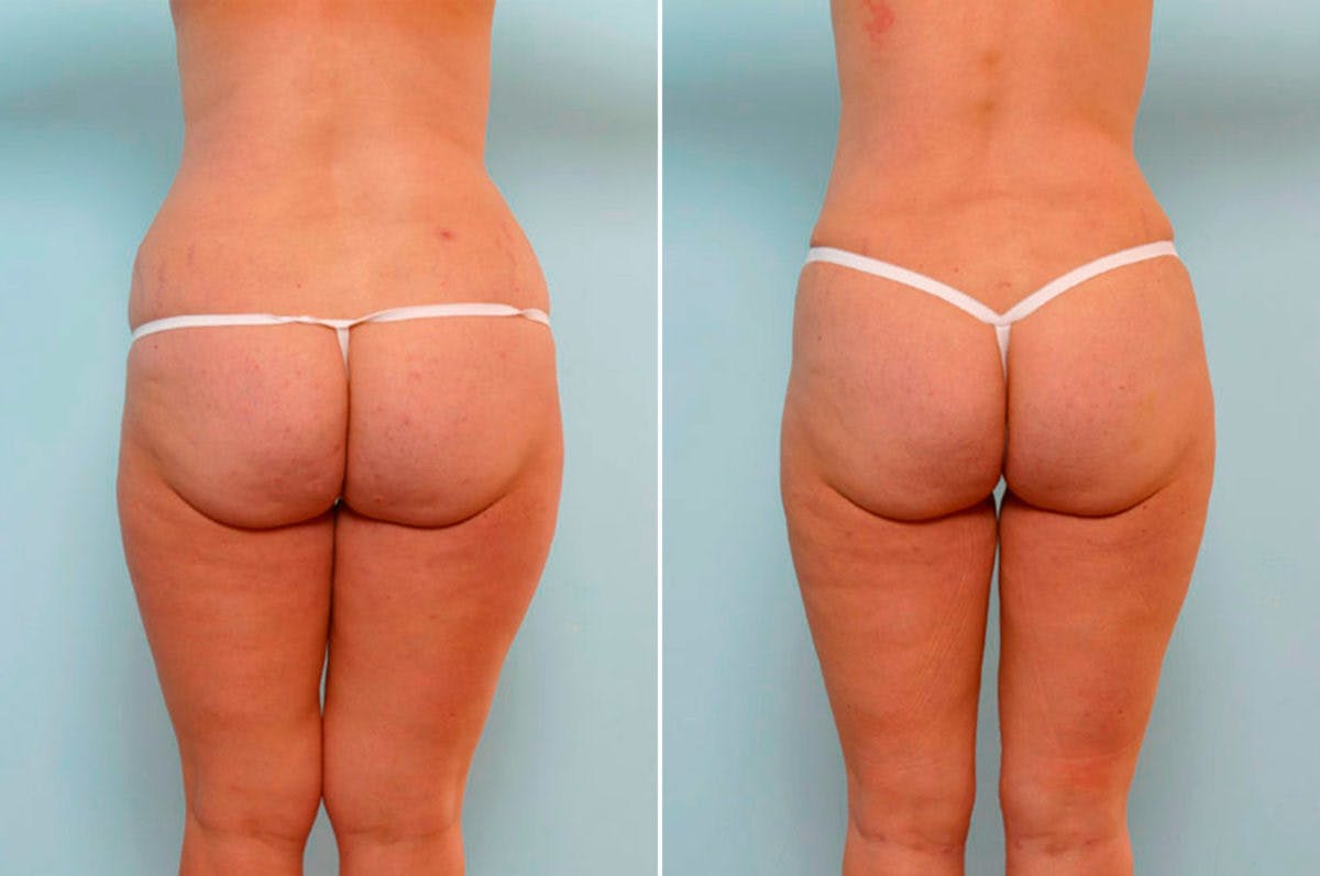 Abdominoplasty Before & After Gallery - Patient 54865571 - Image 4