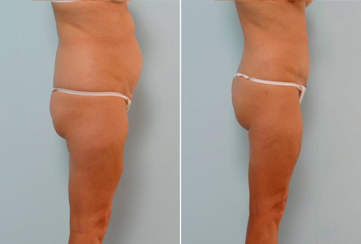 Abdominoplasty Before & After Gallery - Patient 54867071 - Image 3