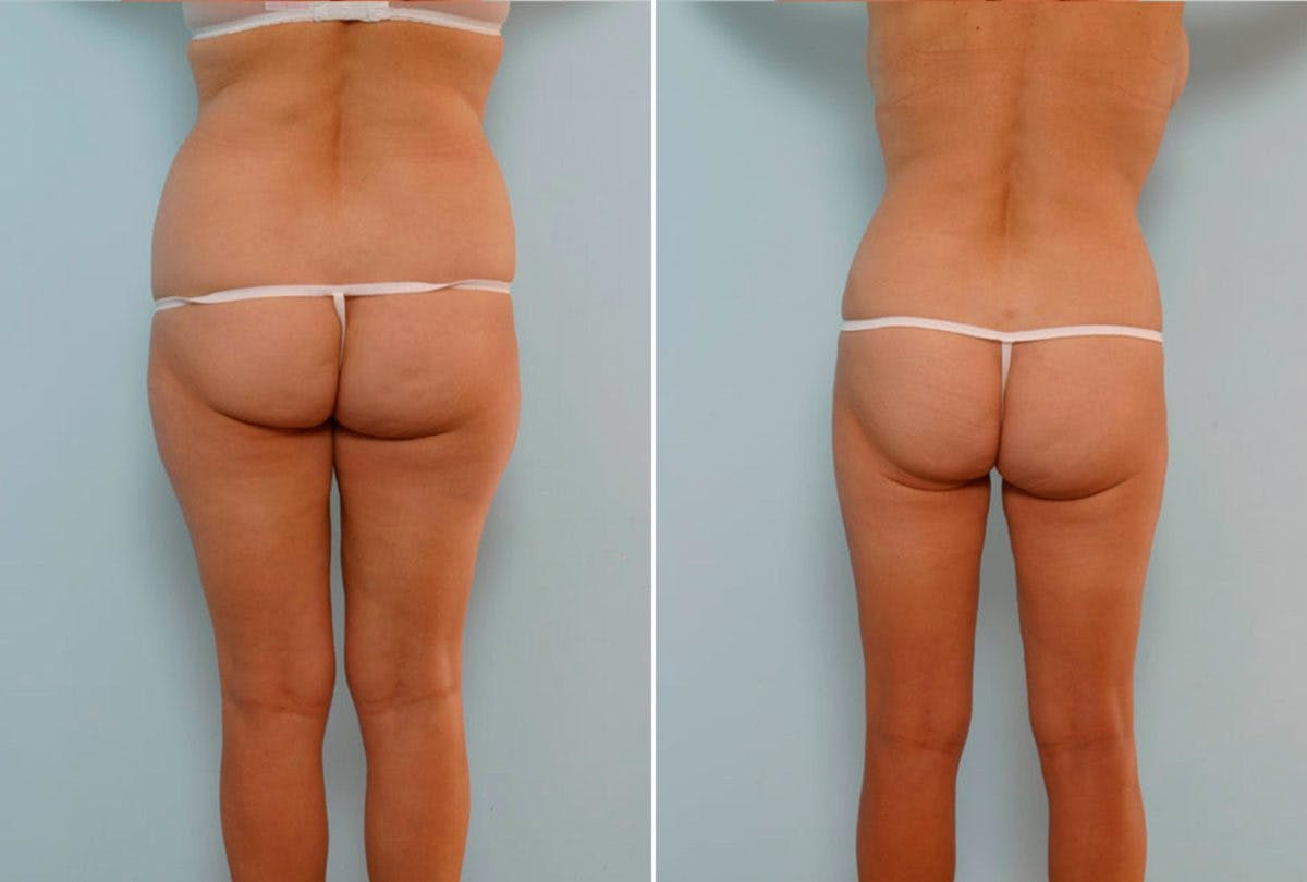 Abdominoplasty Before & After Gallery - Patient 54867071 - Image 4
