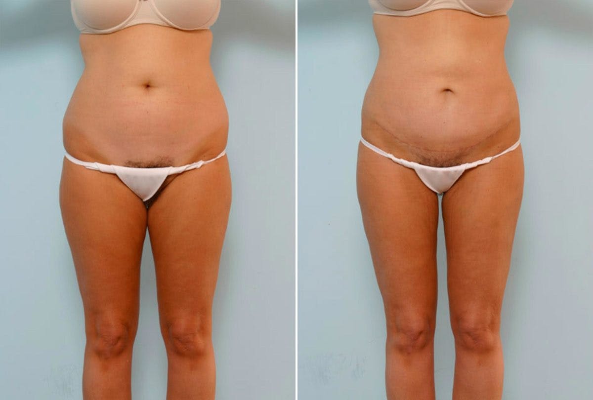 Abdominoplasty Before & After Gallery - Patient 54867072 - Image 1