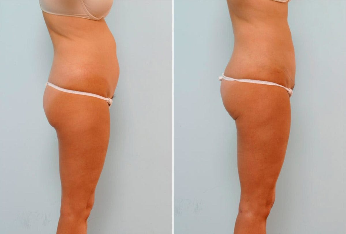 Abdominoplasty Before & After Gallery - Patient 54867072 - Image 2