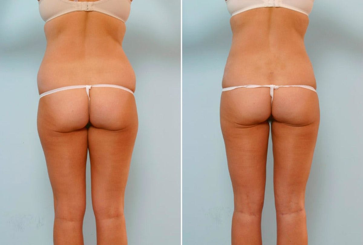 Abdominoplasty Before & After Gallery - Patient 54867072 - Image 3