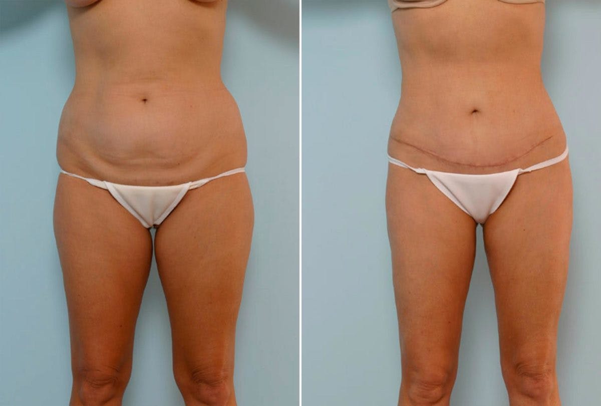 Abdominoplasty Before & After Gallery - Patient 54867073 - Image 1