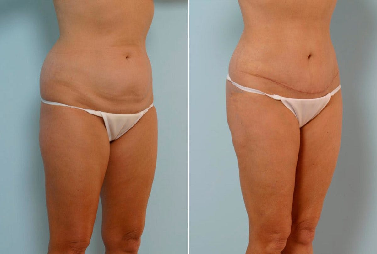 Abdominoplasty Before & After Gallery - Patient 54867073 - Image 2