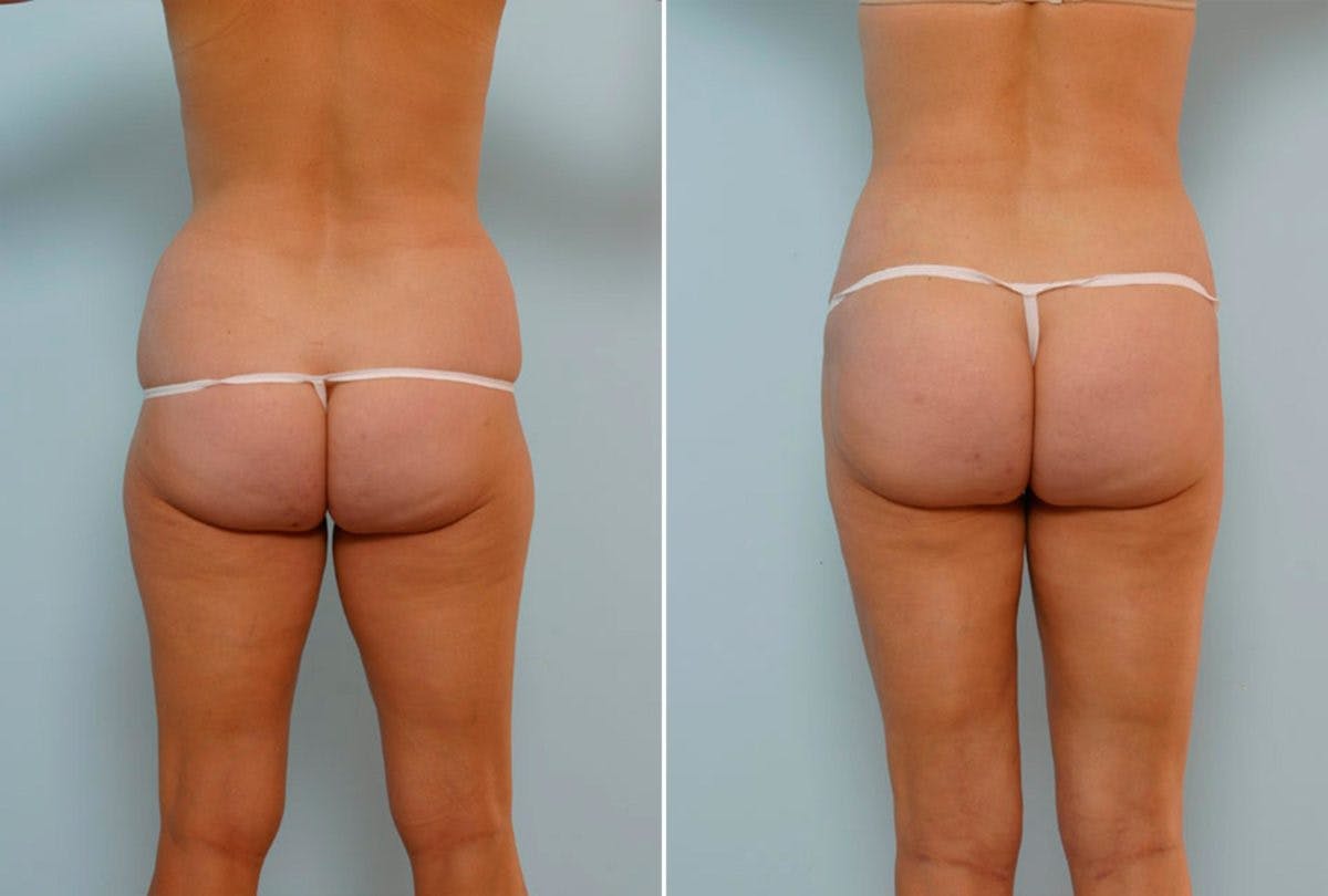 Abdominoplasty Before & After Gallery - Patient 54867073 - Image 4