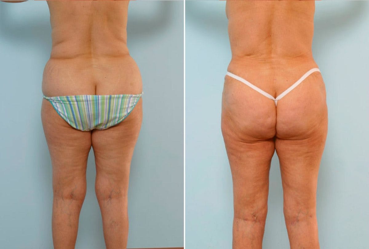 Abdominoplasty Before & After Gallery - Patient 54867076 - Image 4