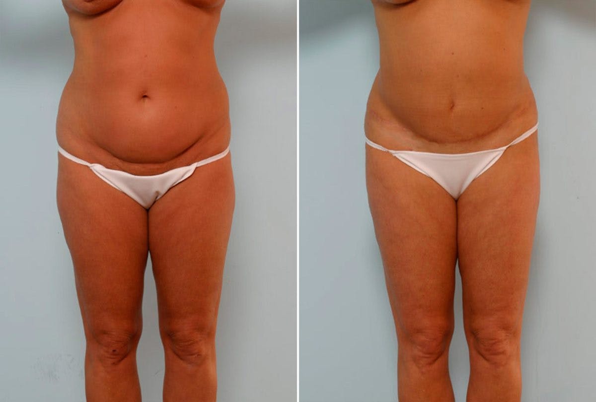 Abdominoplasty Before & After Gallery - Patient 54867077 - Image 1