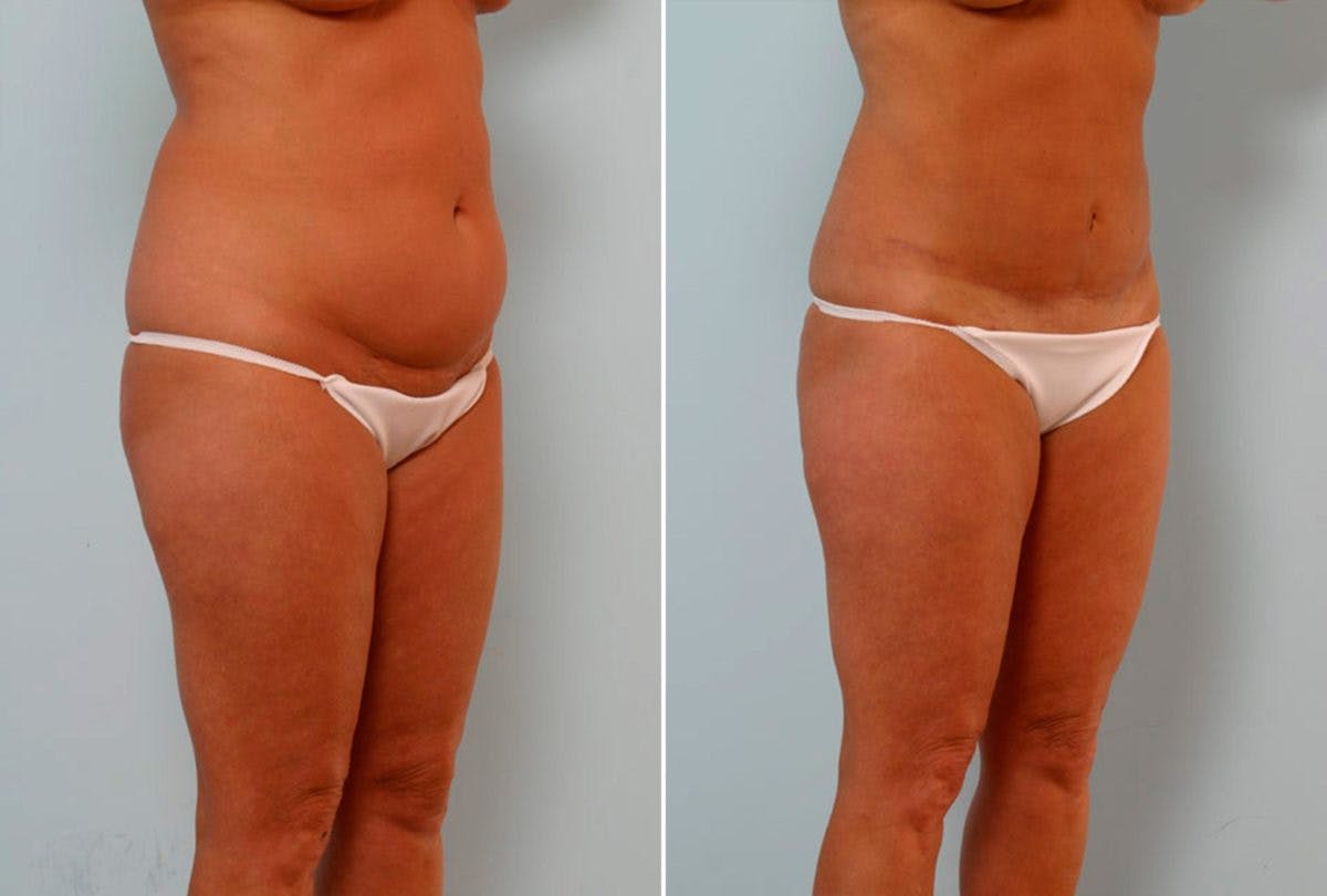 Abdominoplasty Before & After Gallery - Patient 54867077 - Image 2