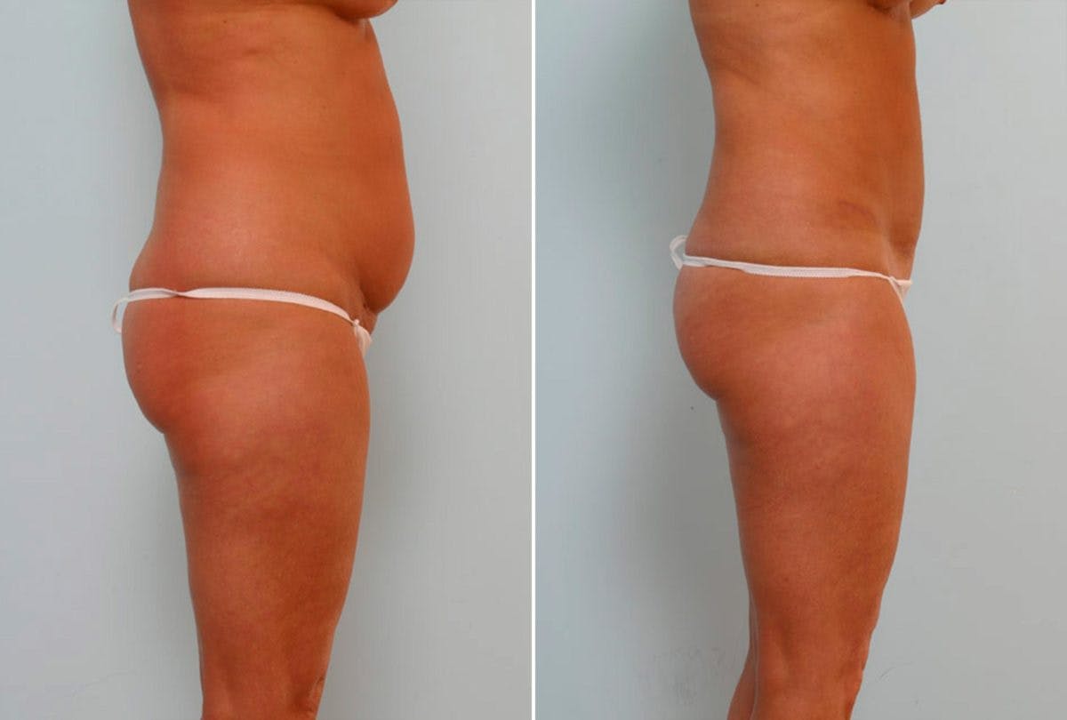 Abdominoplasty Before & After Gallery - Patient 54867077 - Image 3