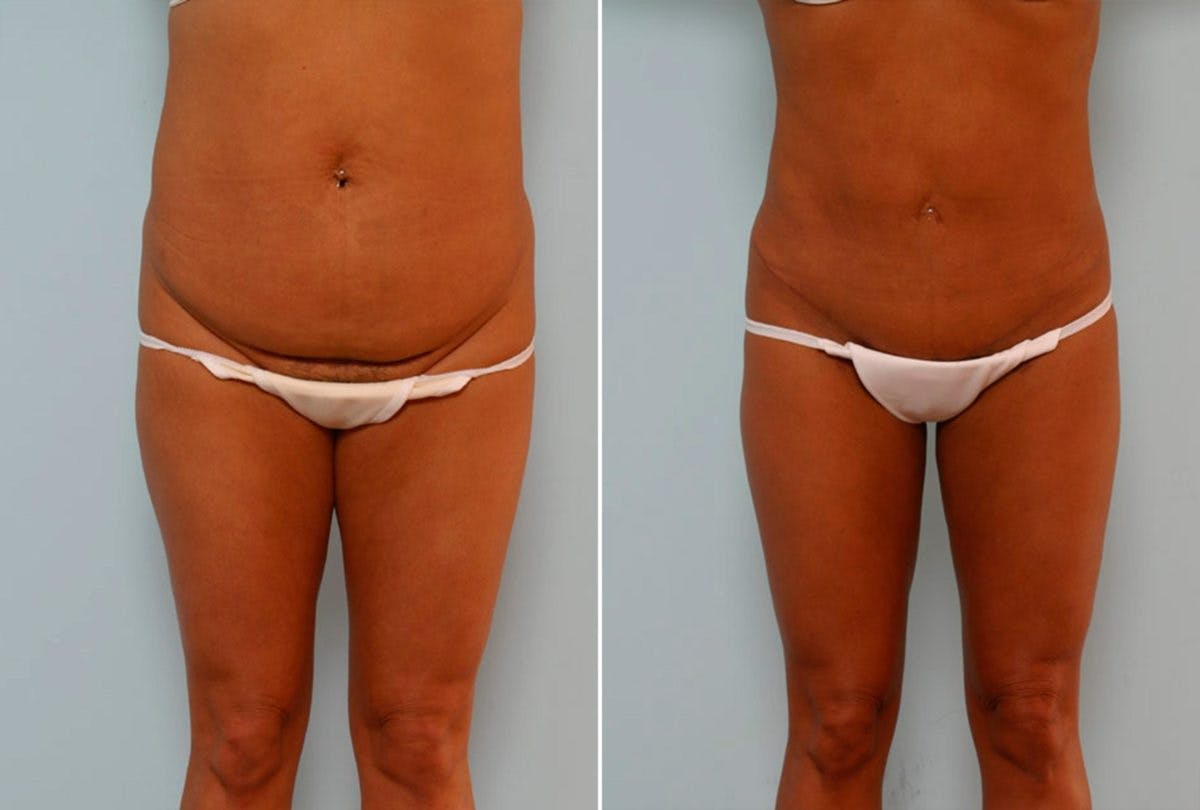 Abdominoplasty Before & After Gallery - Patient 54867078 - Image 1