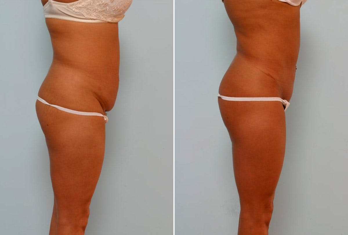 Abdominoplasty Before & After Gallery - Patient 54867078 - Image 3