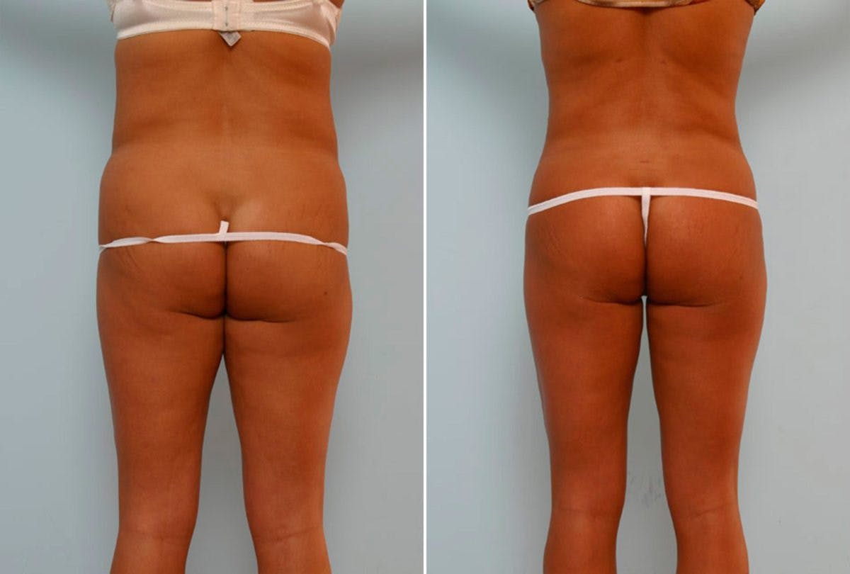 Abdominoplasty Before & After Gallery - Patient 54867078 - Image 4