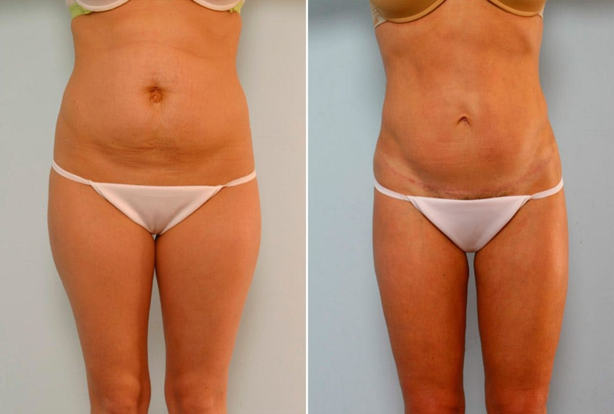 Abdominoplasty Before & After Gallery - Patient 54867081 - Image 1