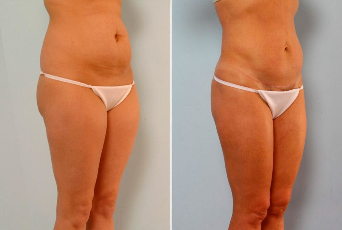 Abdominoplasty Before & After Gallery - Patient 54867081 - Image 2