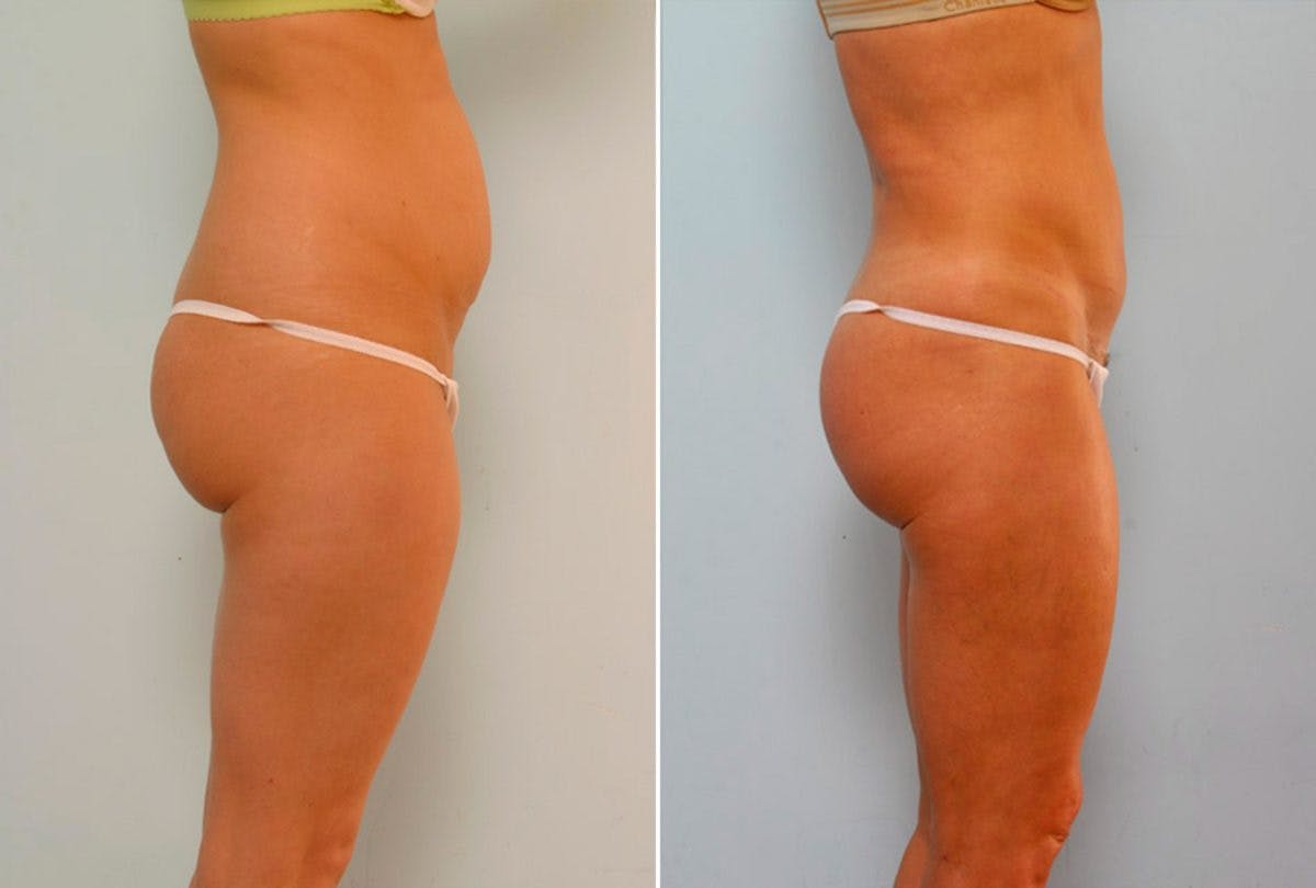 Abdominoplasty Before & After Gallery - Patient 54867081 - Image 3