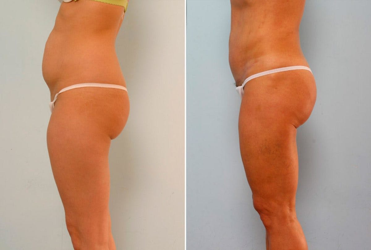 Abdominoplasty Before & After Gallery - Patient 54867081 - Image 5